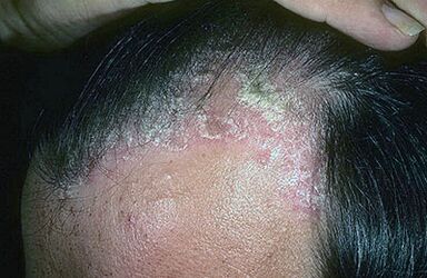 psoriasis of the head photo 1