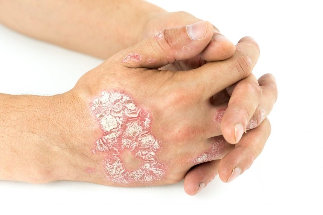 what psoriasis on the hands looks like