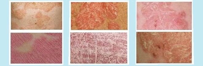 Rashes on the skin characteristic of different types of psoriasis