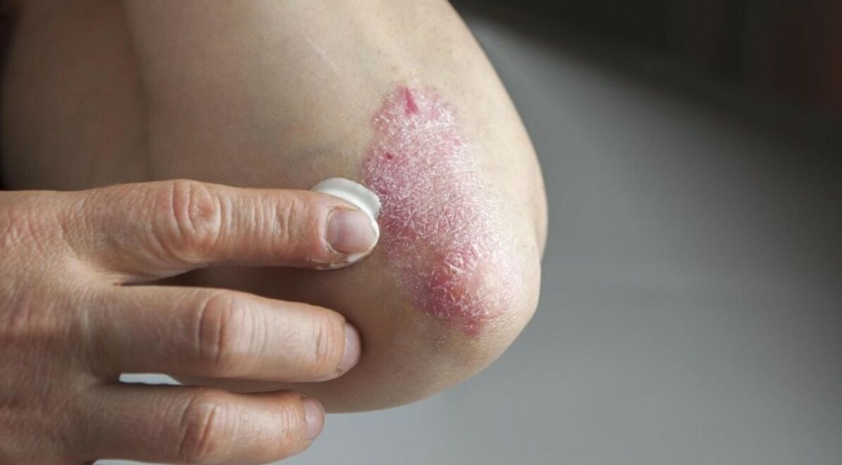 Psoriasis affecting the skin, the treatment of which involves the use of ointments