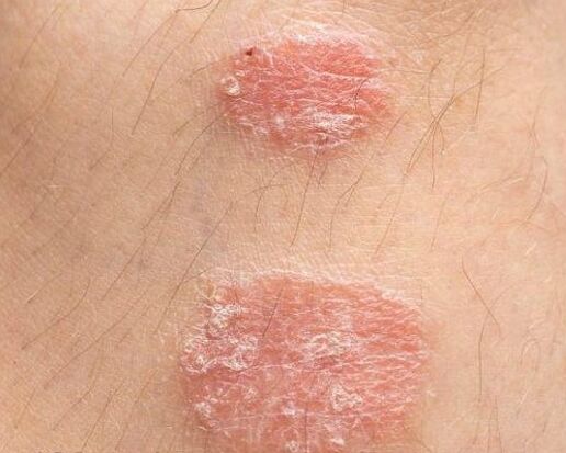 Appearance of psorithic plaques