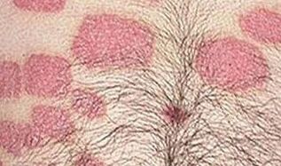 Multiple pink formations on the abdomen