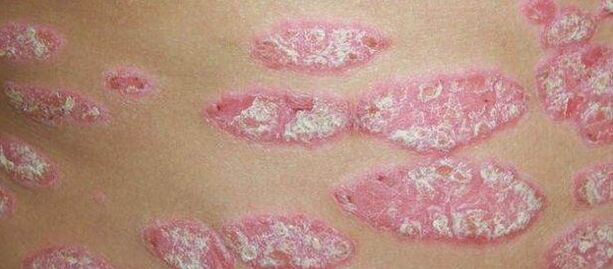 Progressive phase of psoriasis