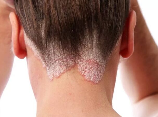 Psorijatska erytroderma