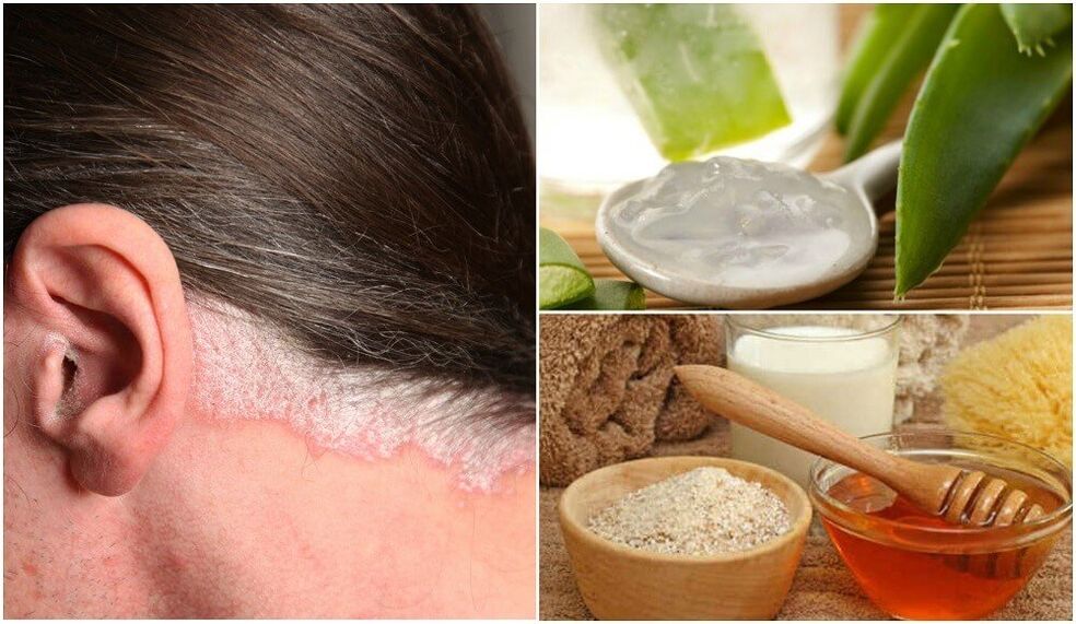 Treatment of psoriasis with folk drugs