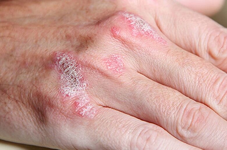 Ladomarna psoriasis