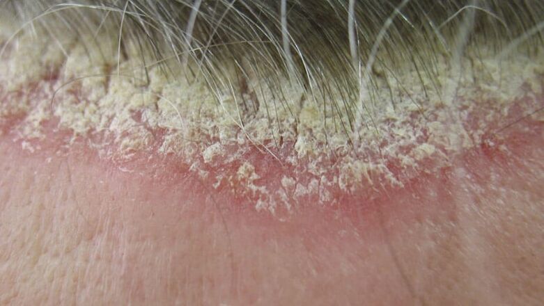 Psoriasis of the scalp