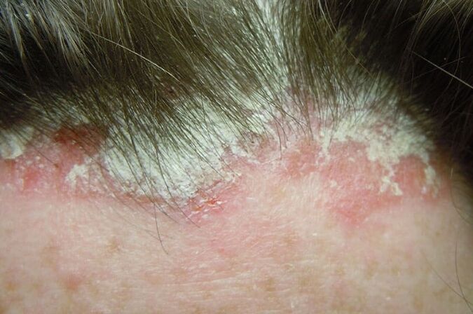 Psoriasis records a whole hairy part of the head