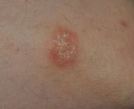 Psoriasis spot