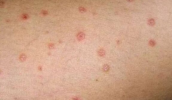 Home Phase of psoriasis