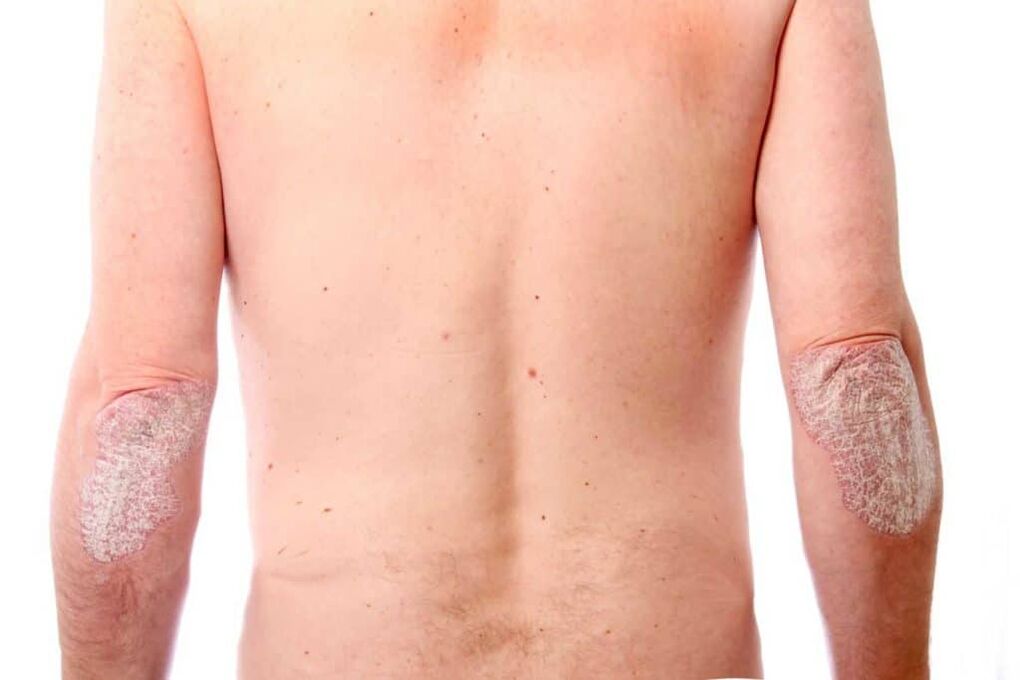 Second phase of psoriasis