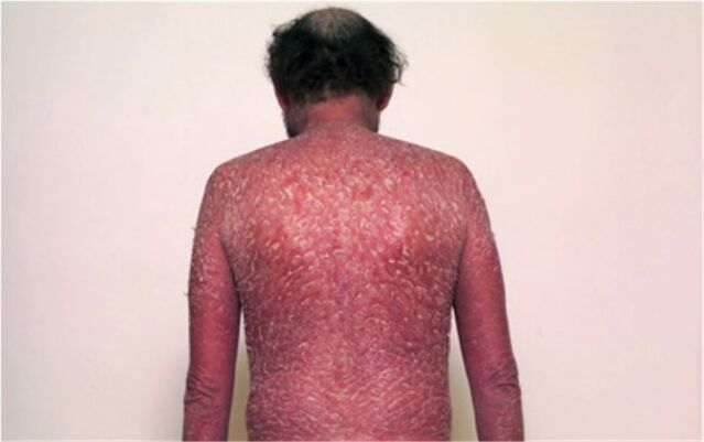 Third phase of psoriasis