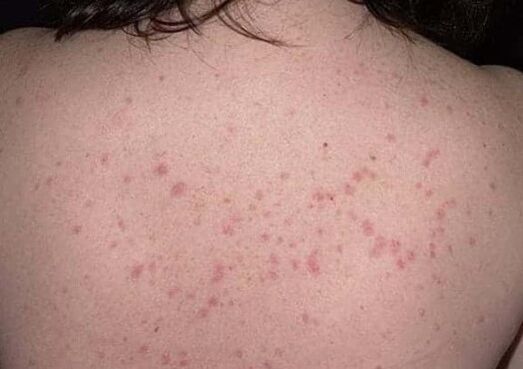 Home Phase of psoriasis
