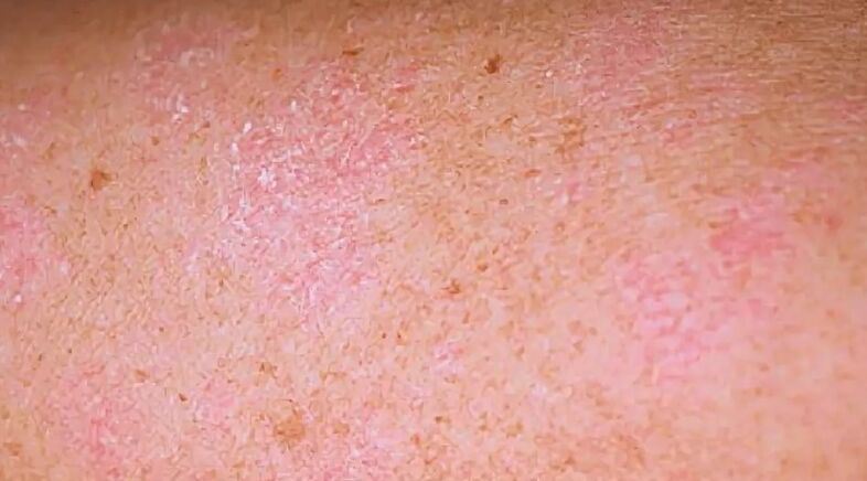 Regressive phase psoriasis