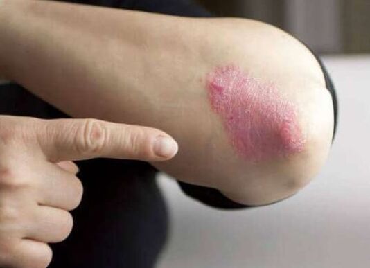 Stationary phase of psoriasis