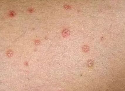 Psoriasis of the initial phase