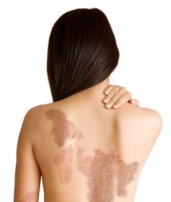 Psoriasis phases depending on the area of ​​lesion