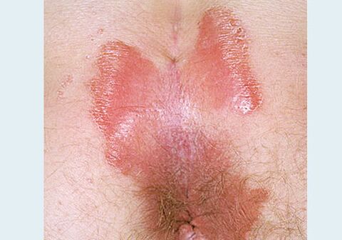 Close - Funny Psoriasis
