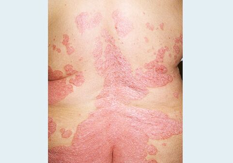 Psoriasis at the rear