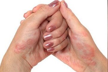 Psoriasis in arms