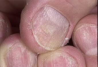 Psoriasis nail