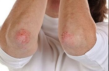 Psoriasis on elbows