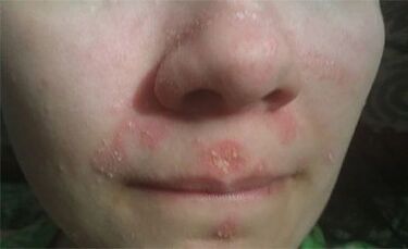 Psoriasis on the face
