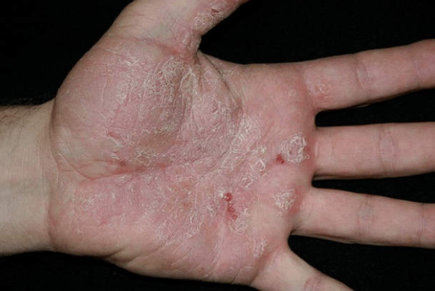 Psoriasis in arms