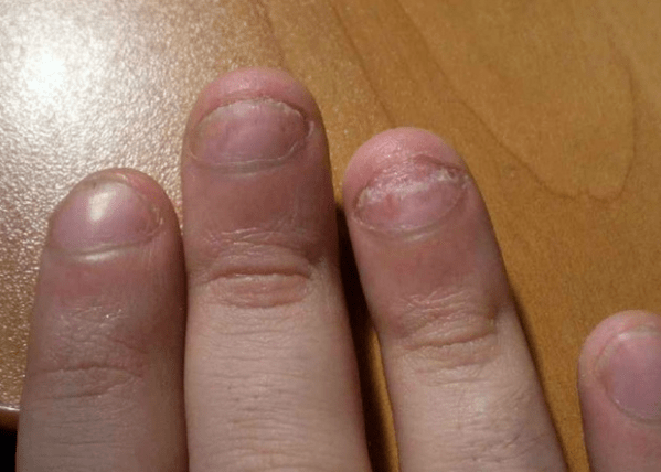 Psoriasis nail