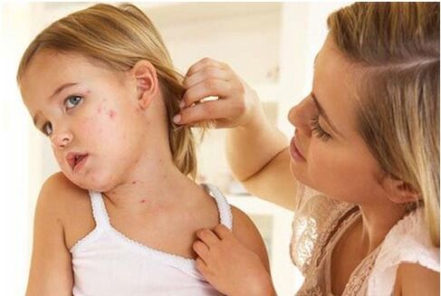 Photo of the initial phase of psoriasis