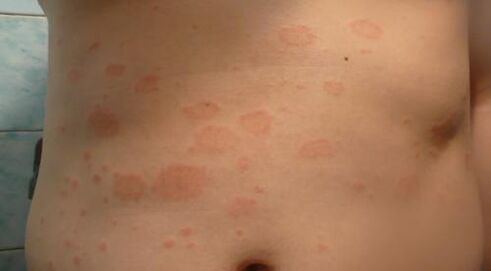 Psoriasis of the initial phase