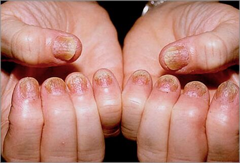 nail psoriasis