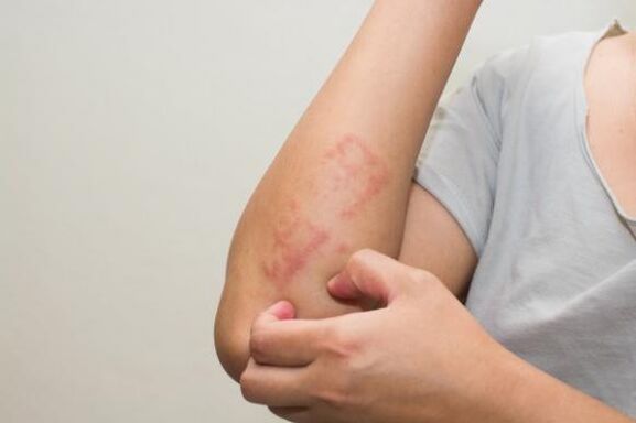 Latest Psoriasis Treatment Methods