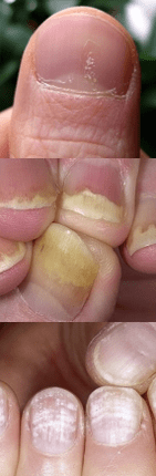 Nail psoriasis - Home Phase