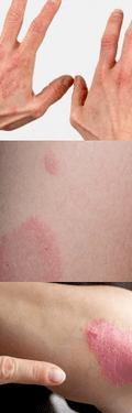 Psoriasis of the initial phase on his hands