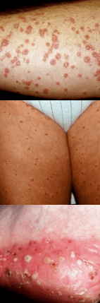 Psoriasis on the legs