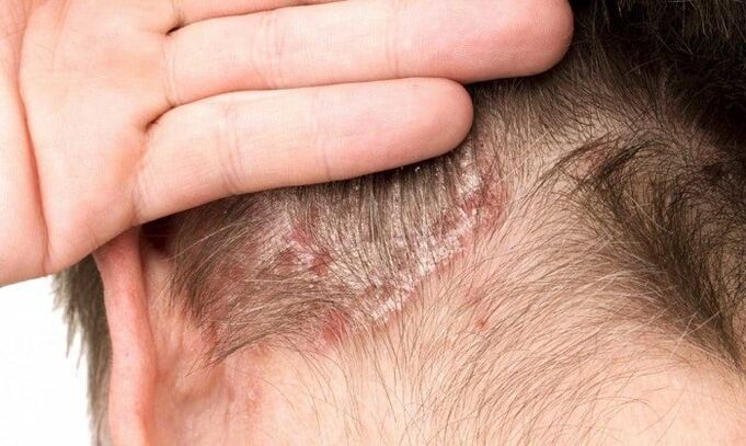 scalp psoriasis