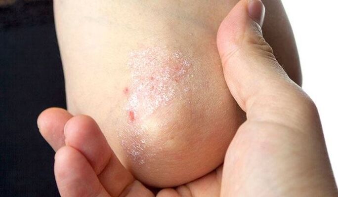symptoms of psoriasis in the initial stage