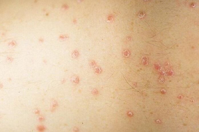 symptoms of spot psoriasis