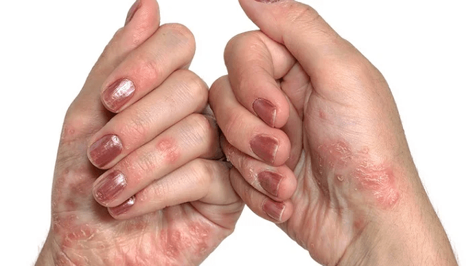 Home Phase of psoriasis