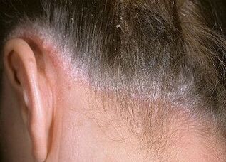 causes of psoriasis of the head