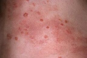 photo of psoriasis of the skin