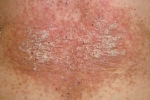 sational phase of psoriasis