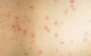 a photograph of the initial stage of psoriasis