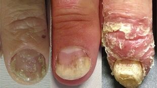 stages of nail psoriasis development